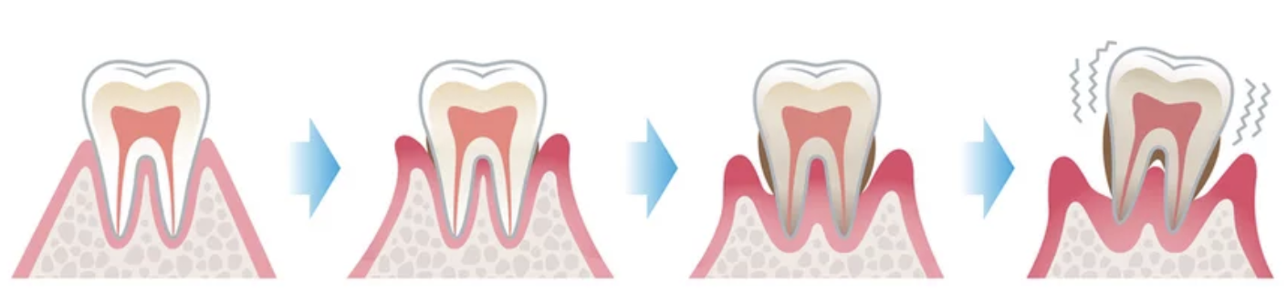 periodontal disease