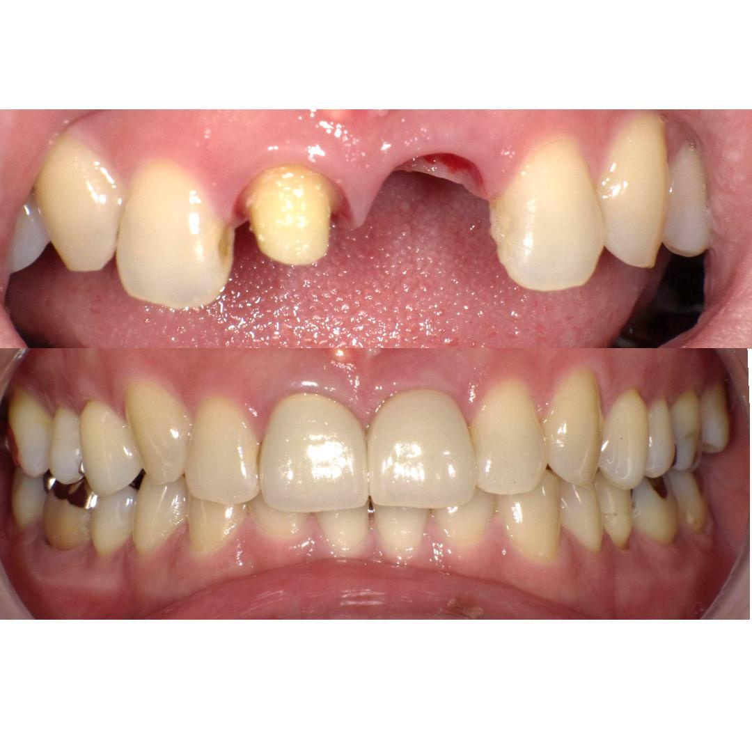 東白楽ハシビロ歯科　インプラント　人工歯根