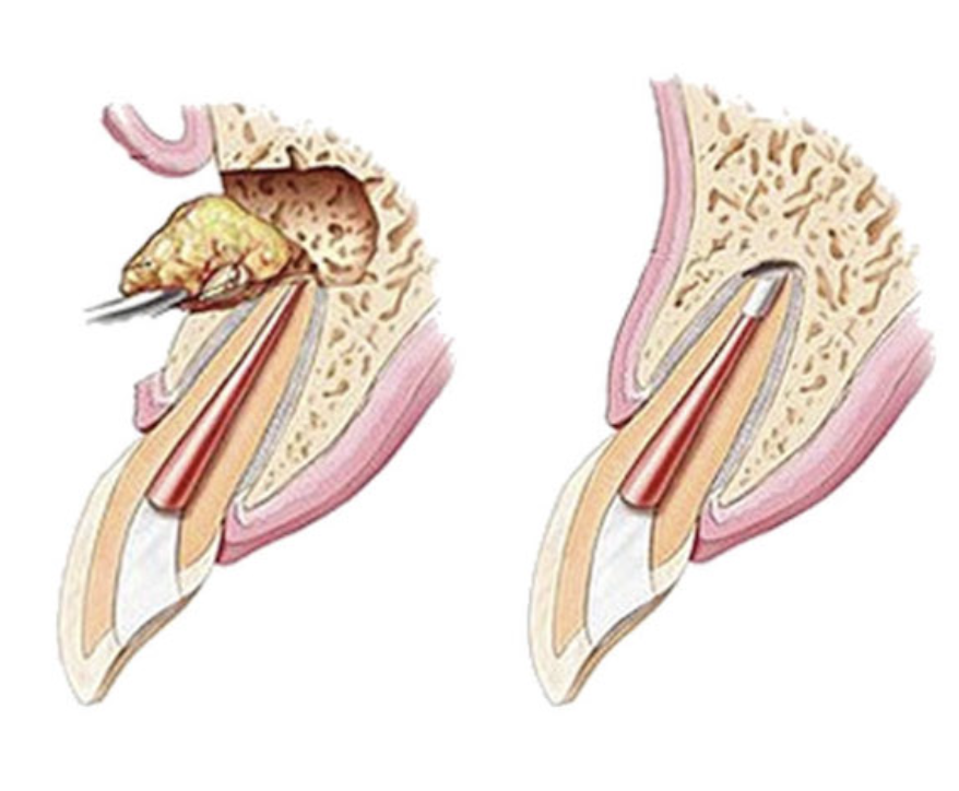 apicoectomy