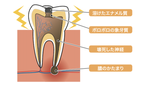 rootcanal