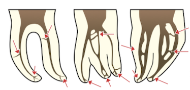 rootcanal