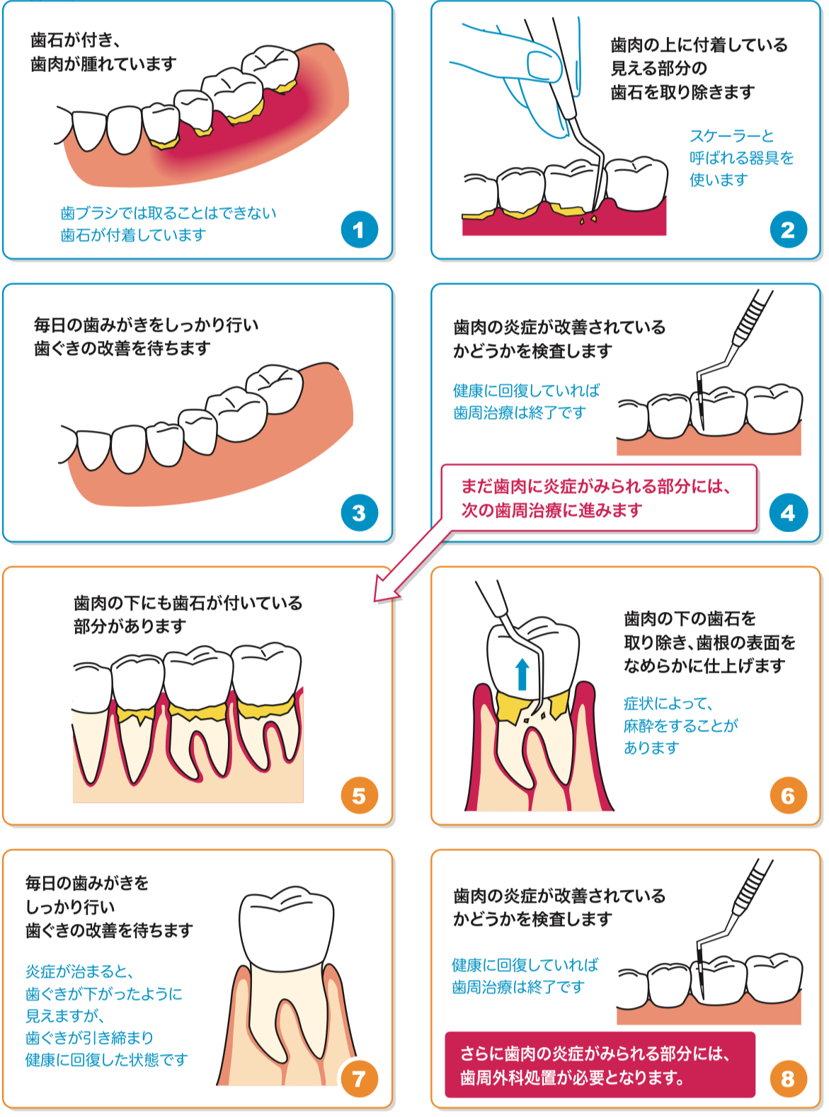 periodontal disease treatment steps